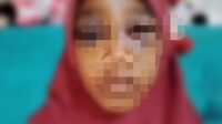 Siswa Kelas Empat SD Dilebak Dianiaya Ayah Tiri Hingga Memar