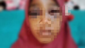 Siswa Kelas Empat SD Dilebak Dianiaya Ayah Tiri Hingga Memar